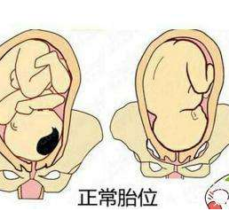 中医教你如何按摩至阴穴矫正胎位？