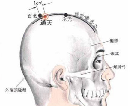 通天穴治疗鼻炎