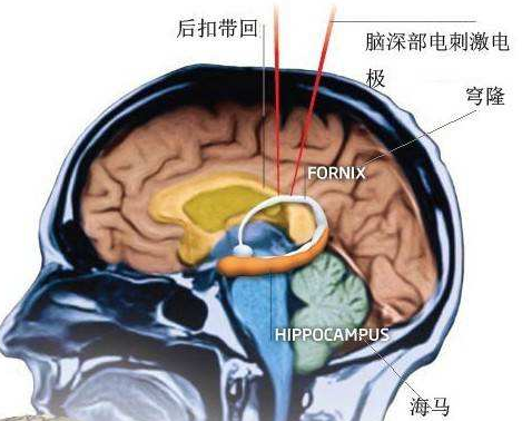 脑外伤伴发的精神障碍示意图