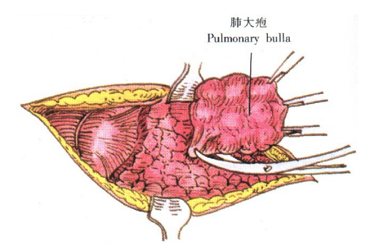 肺大疱的症状表现