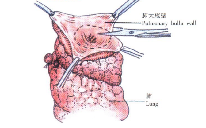 肺大疱的治疗方法