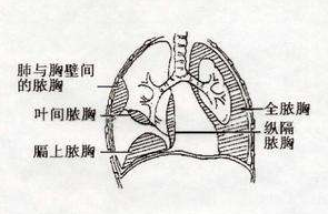 胆固醇脓胸