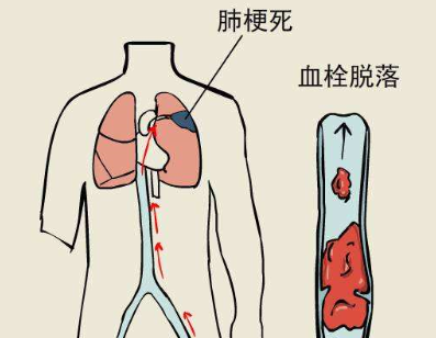 肺栓塞和肺梗死