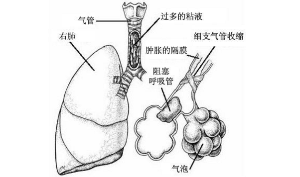 肺炎的发病原因